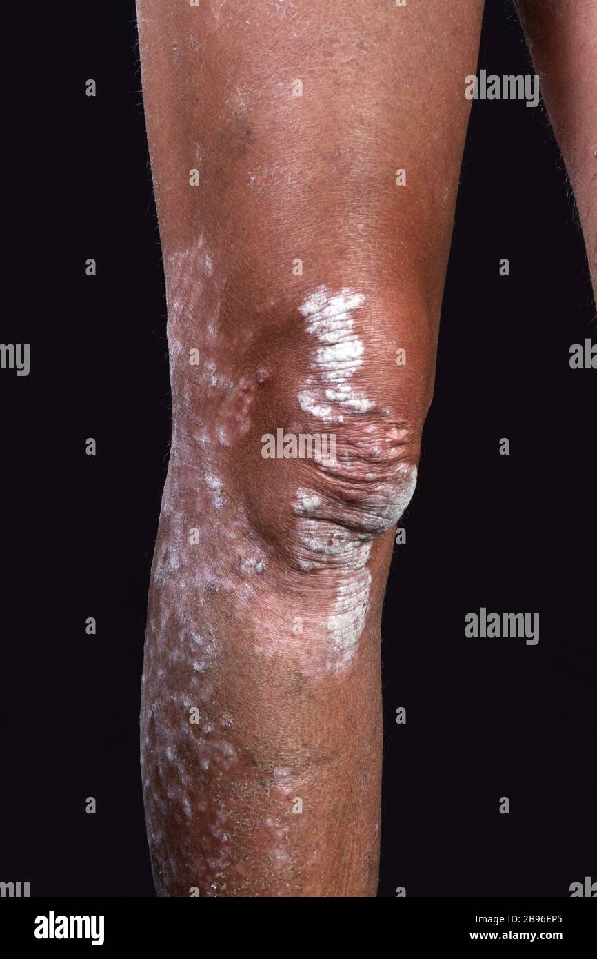 skin diseases - psoriasis on the legs Stock Photo - Alamy