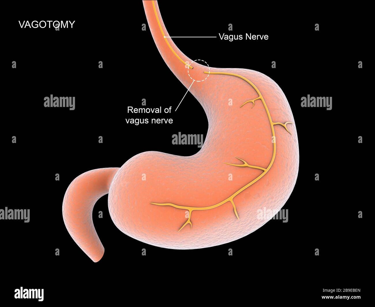 Vagotomy surgical procedure to remove part of the vagus nerve. Stock Photo