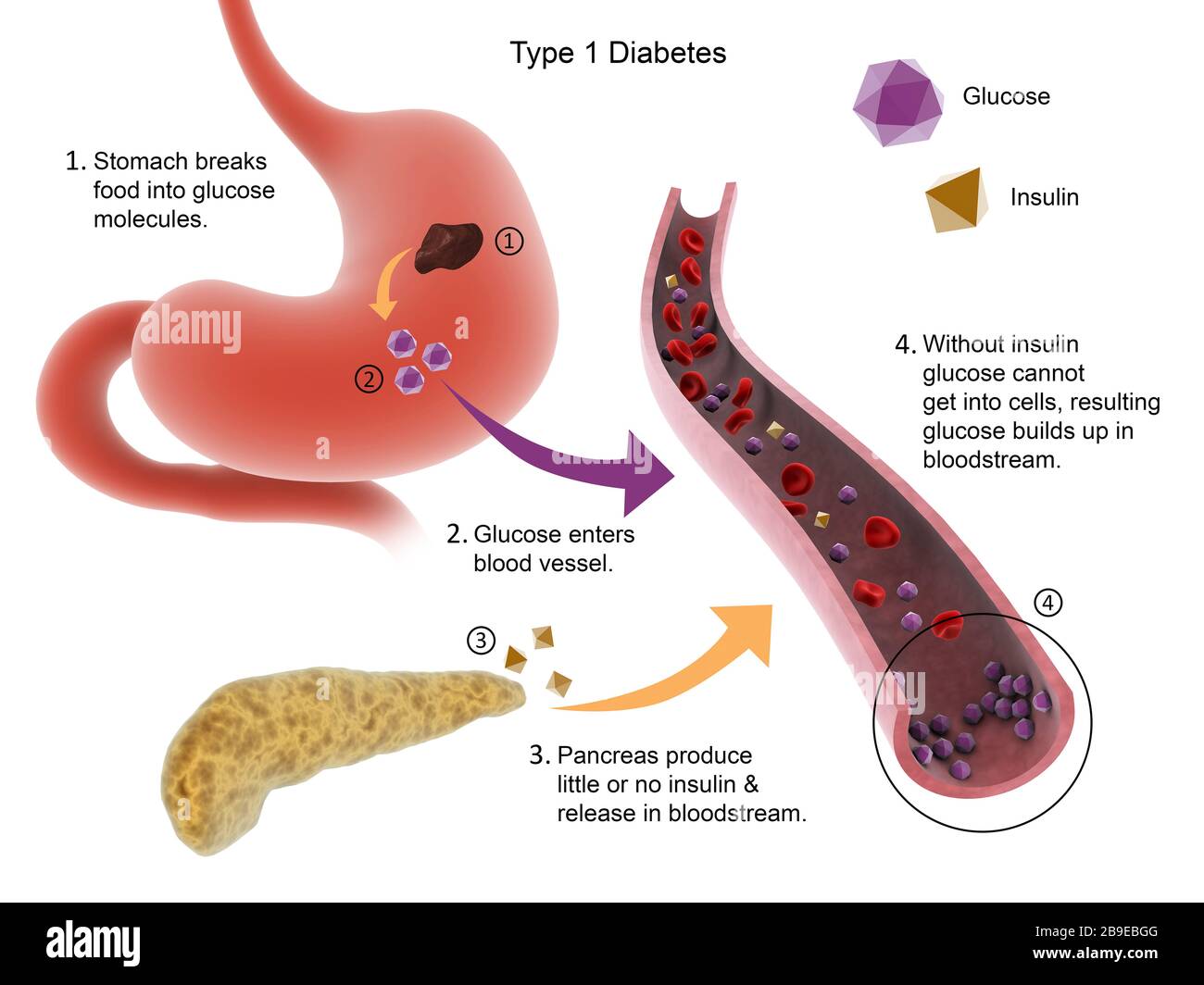Medical diagram of Type 1 diabetes. Stock Photo