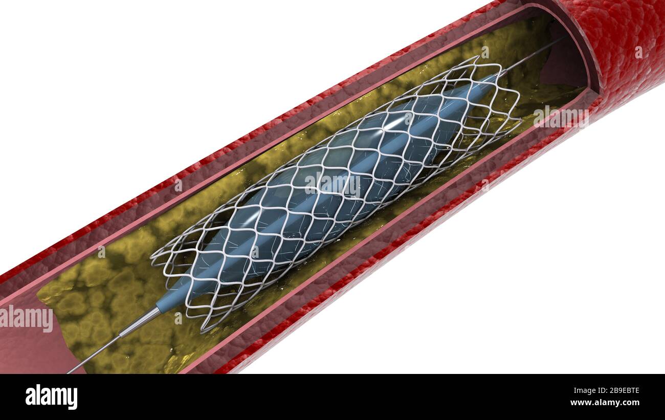 Cross-section of artery showing angioplasty and stent deployment. Stock Photo