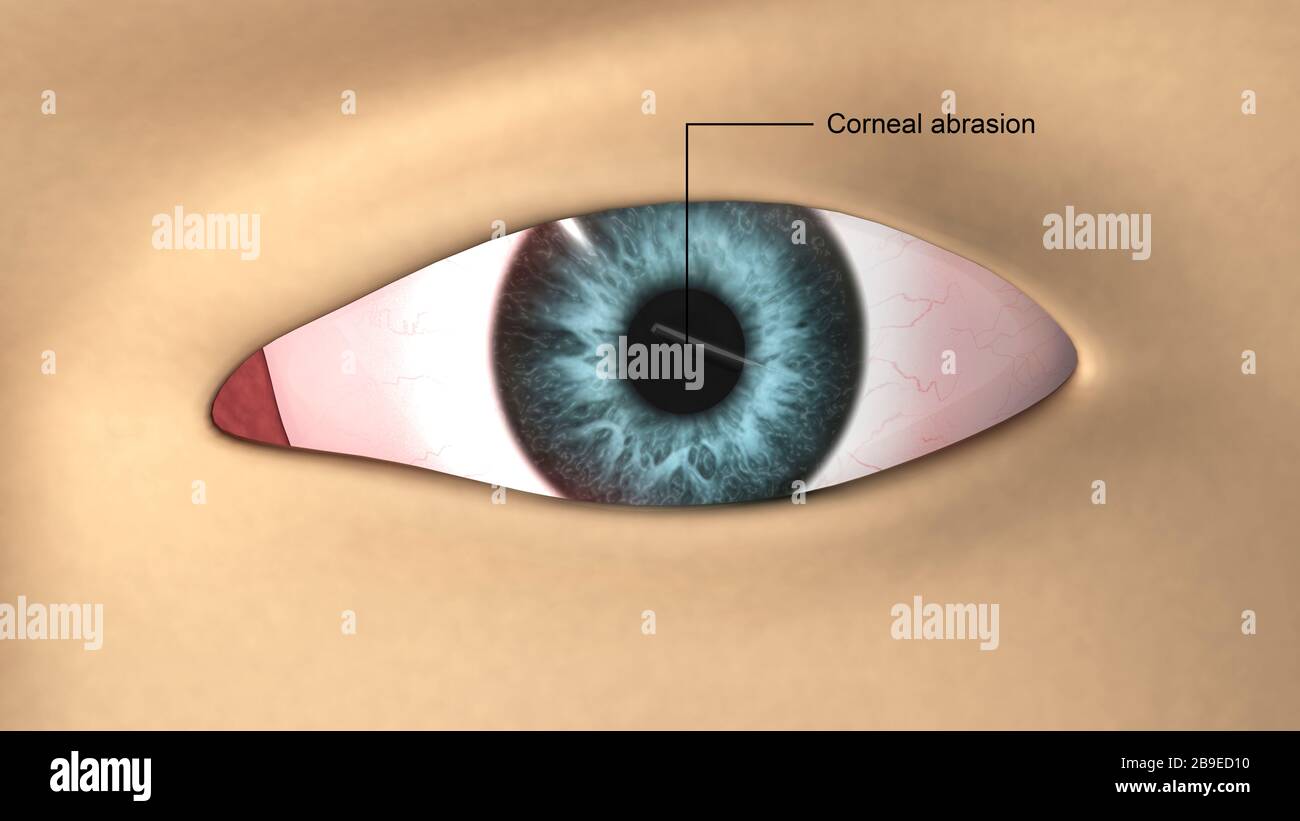 Corneal abrasion in the human eye Stock Photo Alamy