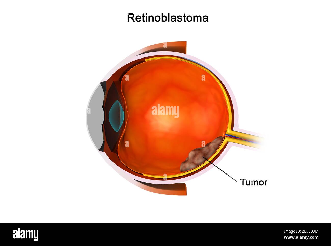 Medical illustration of retinoblastoma tumor in the retina of eye. Stock Photo