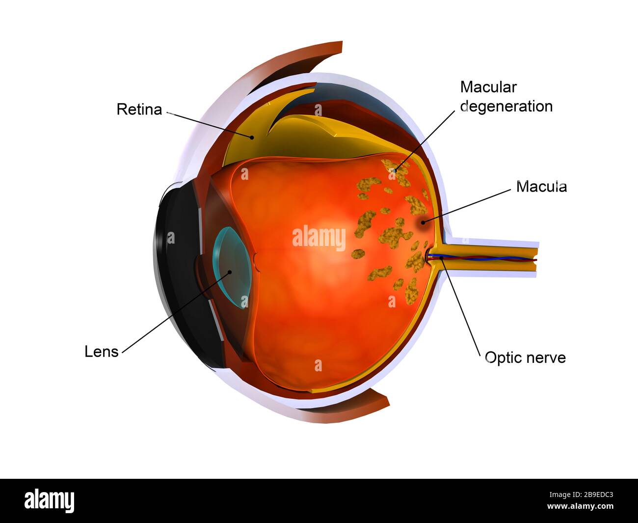 Biomedical illustration of macular degeneration. Stock Photo