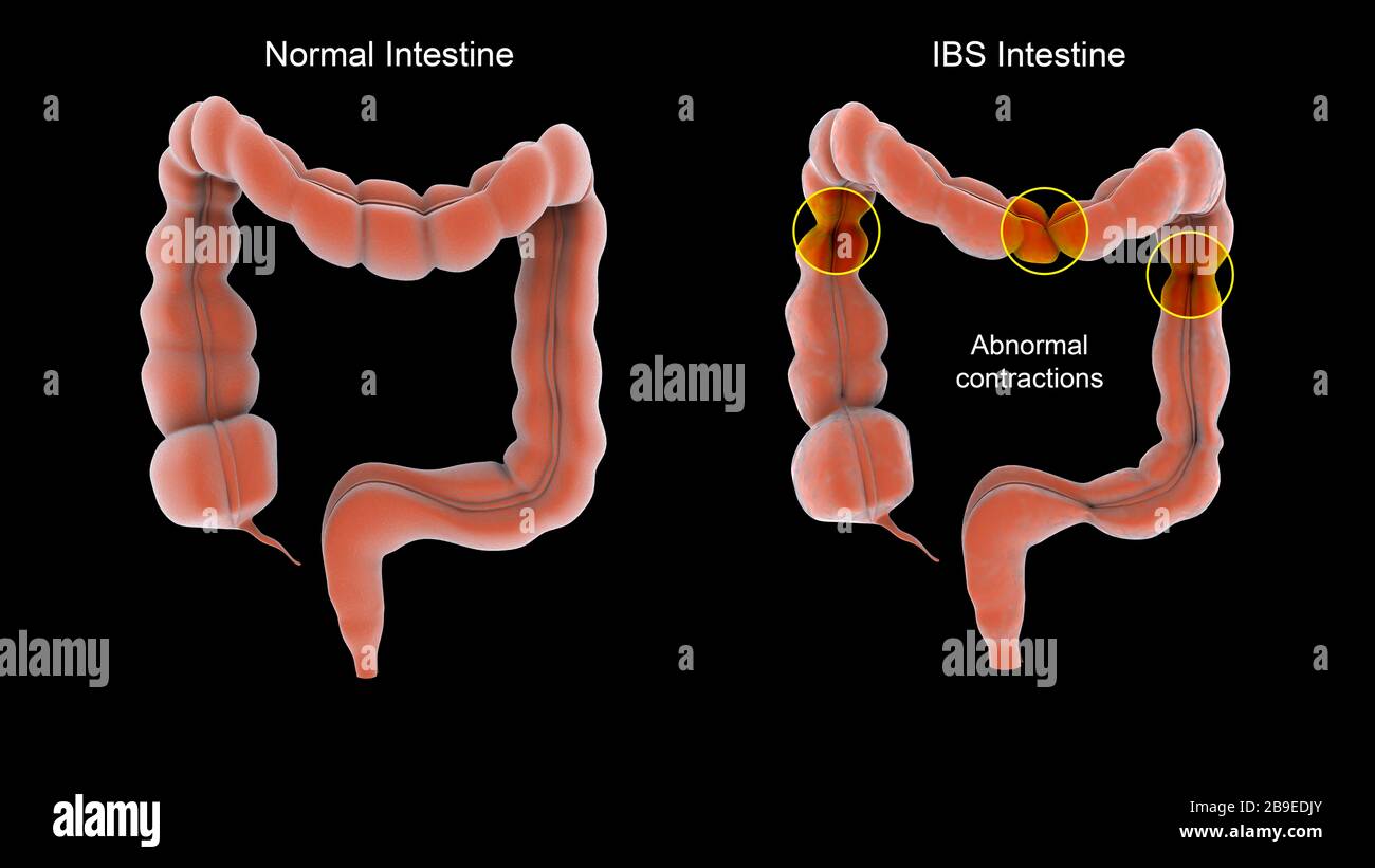 Normal vs. abnormal contractions associated with irritable bowel syndrome in the human intestines. Stock Photo