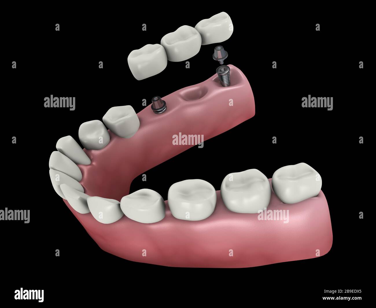 Medical illustration of a dental bridge. Stock Photo