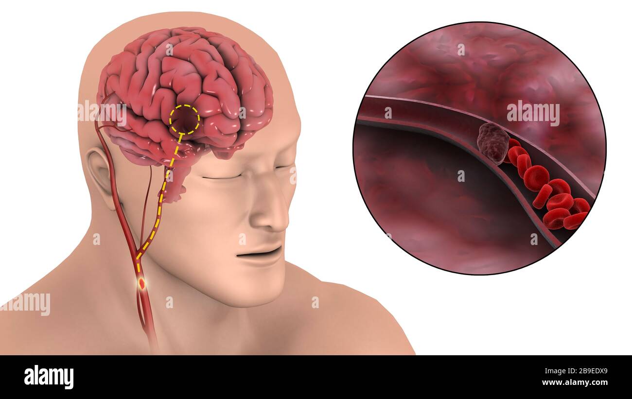 Medical illustration of an ischemic stroke. Stock Photo