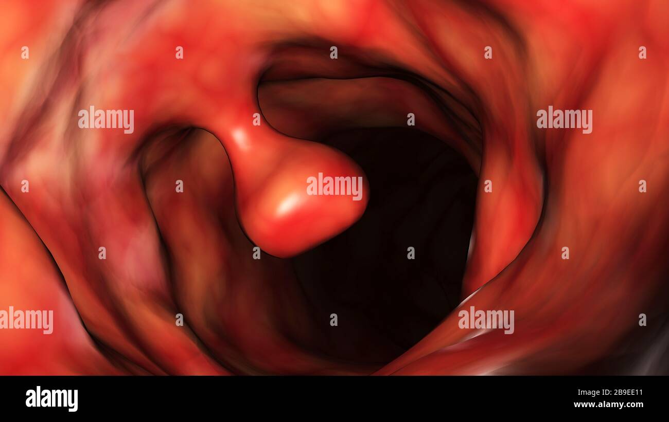 Illustrative close-up of a colon polyp. Stock Photo