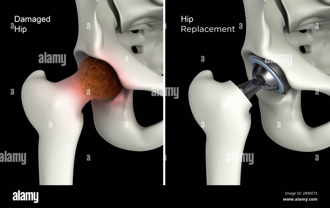 Medical illustration showing hip replacement of a damaged hip. Stock Photo