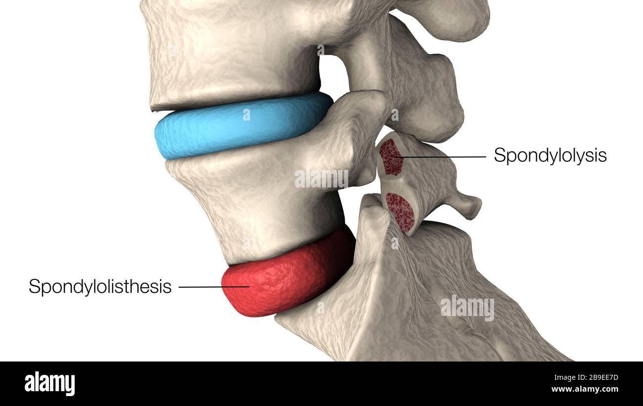 Illustration highlighting spondylolisthesis and spondylolysis in the human vertebra. Stock Photo