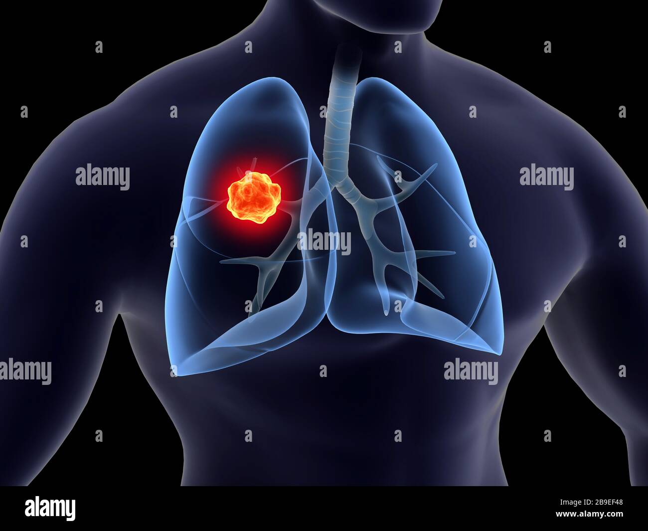 Medical illustration of lung cancer inside the human lungs. Stock Photo