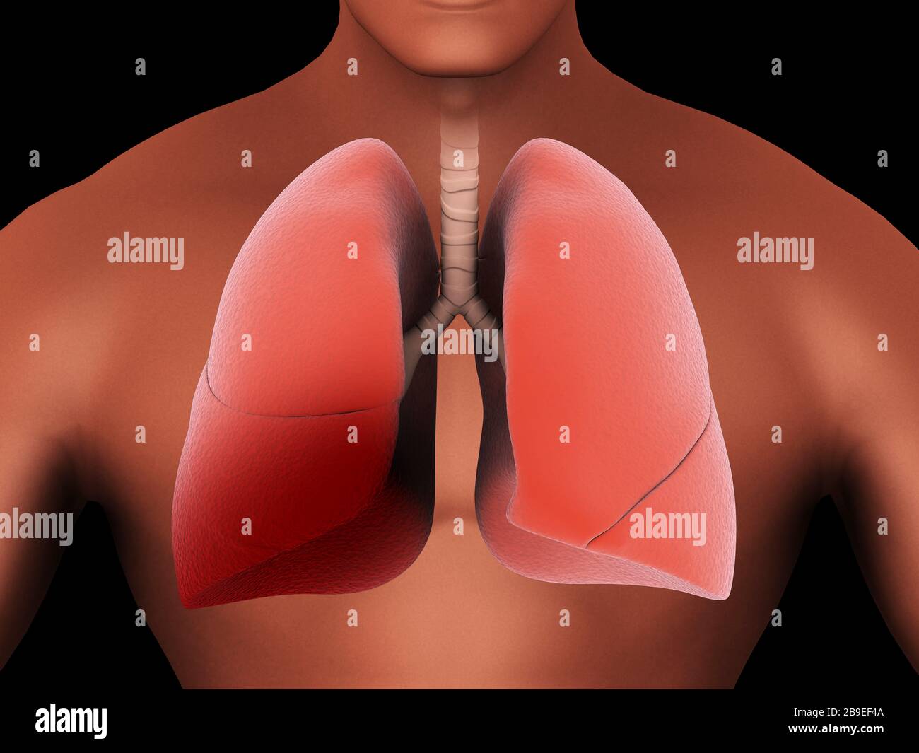 Inflammation in the human lungs caused by pneumonia. Stock Photo