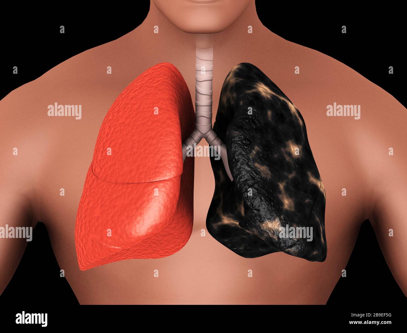Comparison of a healthy lung vs. a smoker's lung. Stock Photo