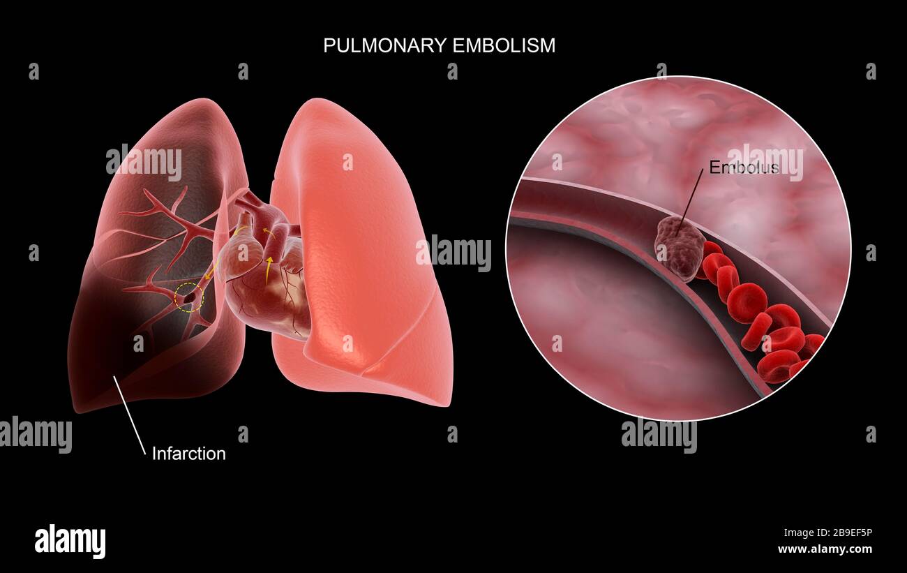 Medical concept showing pulmonary embolism in the human lungs. Stock Photo
