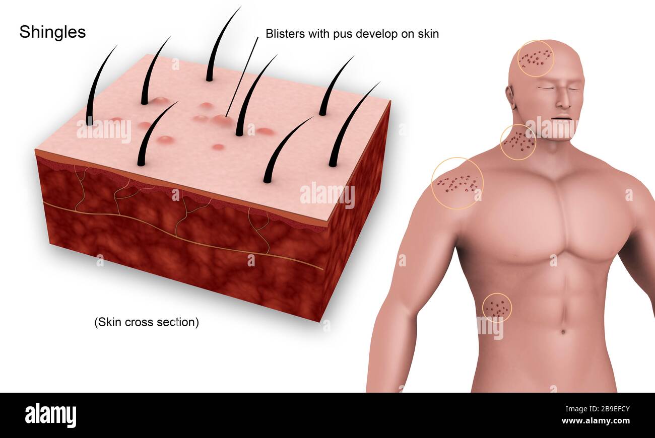 Medical diagram showing shingles caused by the varicella-zoster virus. Stock Photo