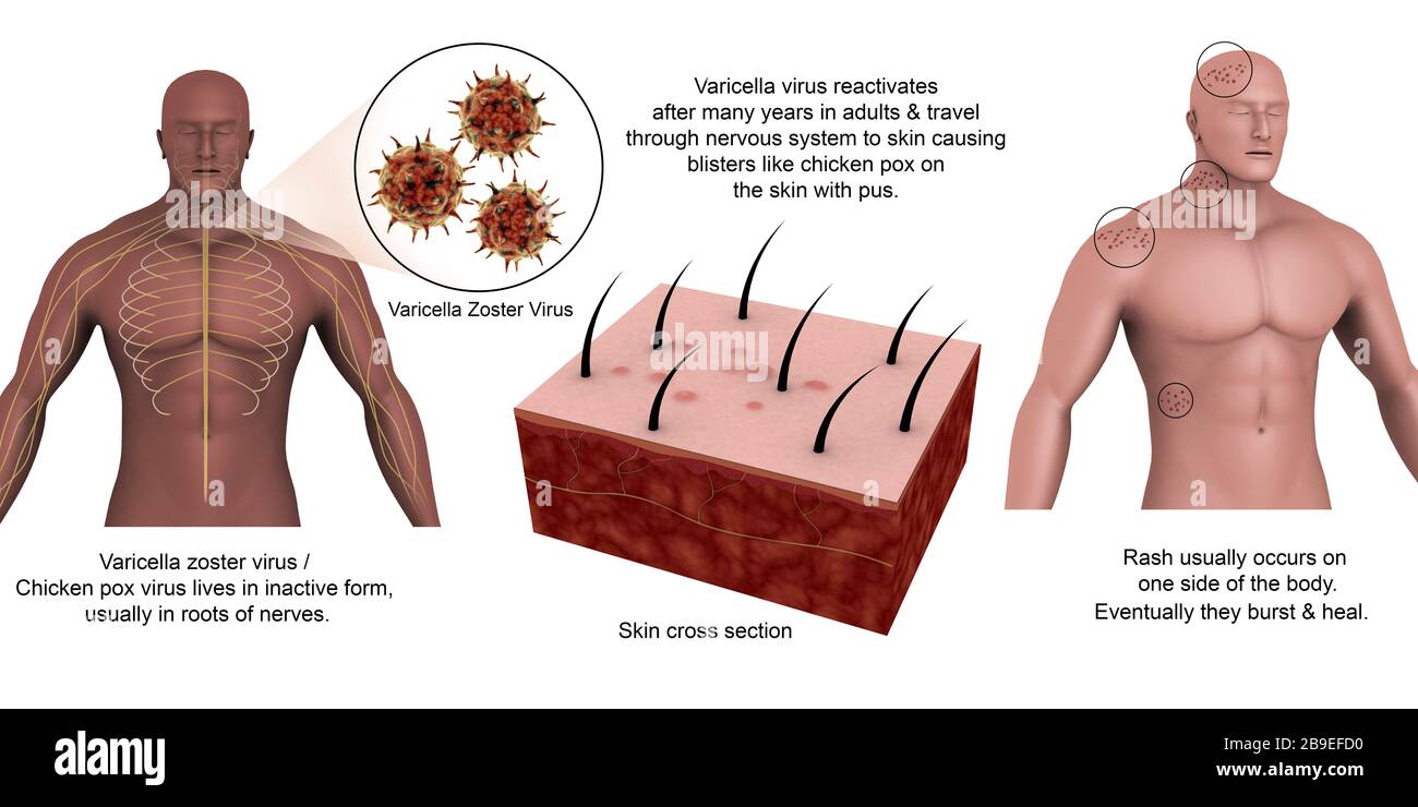 Medical diagram showing shingles caused by the varicella-zoster virus. Stock Photo