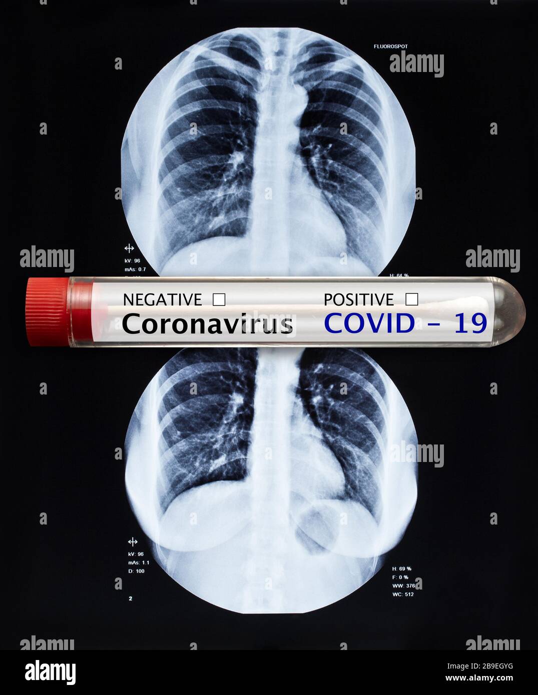 Coronavirus blood  test tube and X-Ray Image Of Human Chest for a medical diagnosis. Covid-19 pandemics Stock Photo