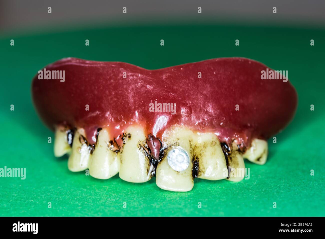 Upper jaw prosthesis with dentures Stock Photo