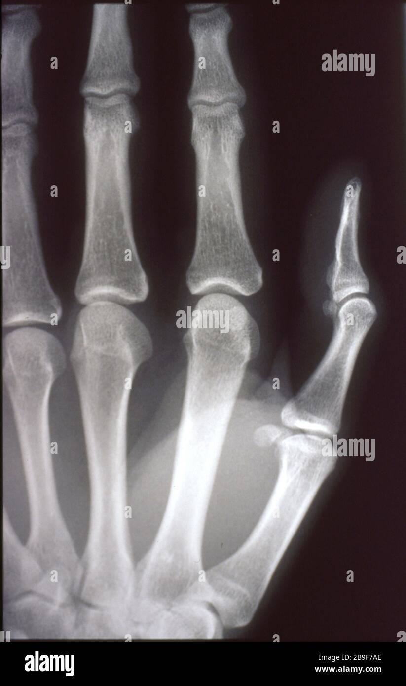 X-ray image, man, hand with bones and joints Stock Photo - Alamy