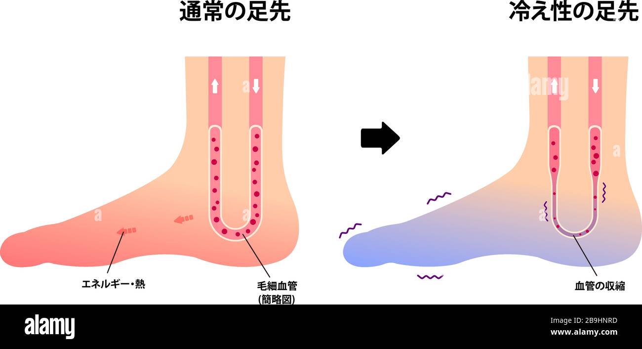 Comparison Illustration Of Normal Foot And Cold Foot Sensitivity To Cold Cold Toes Japanese Stock Vector Image Art Alamy