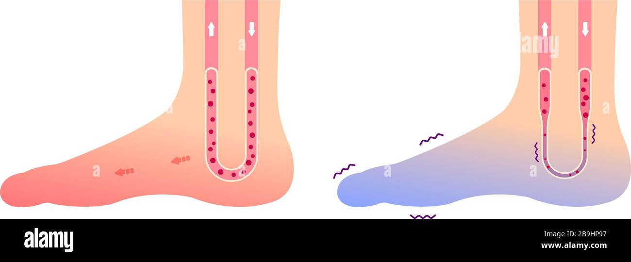 Comparison illustration of normal foot and cold foot ( sensitivity to