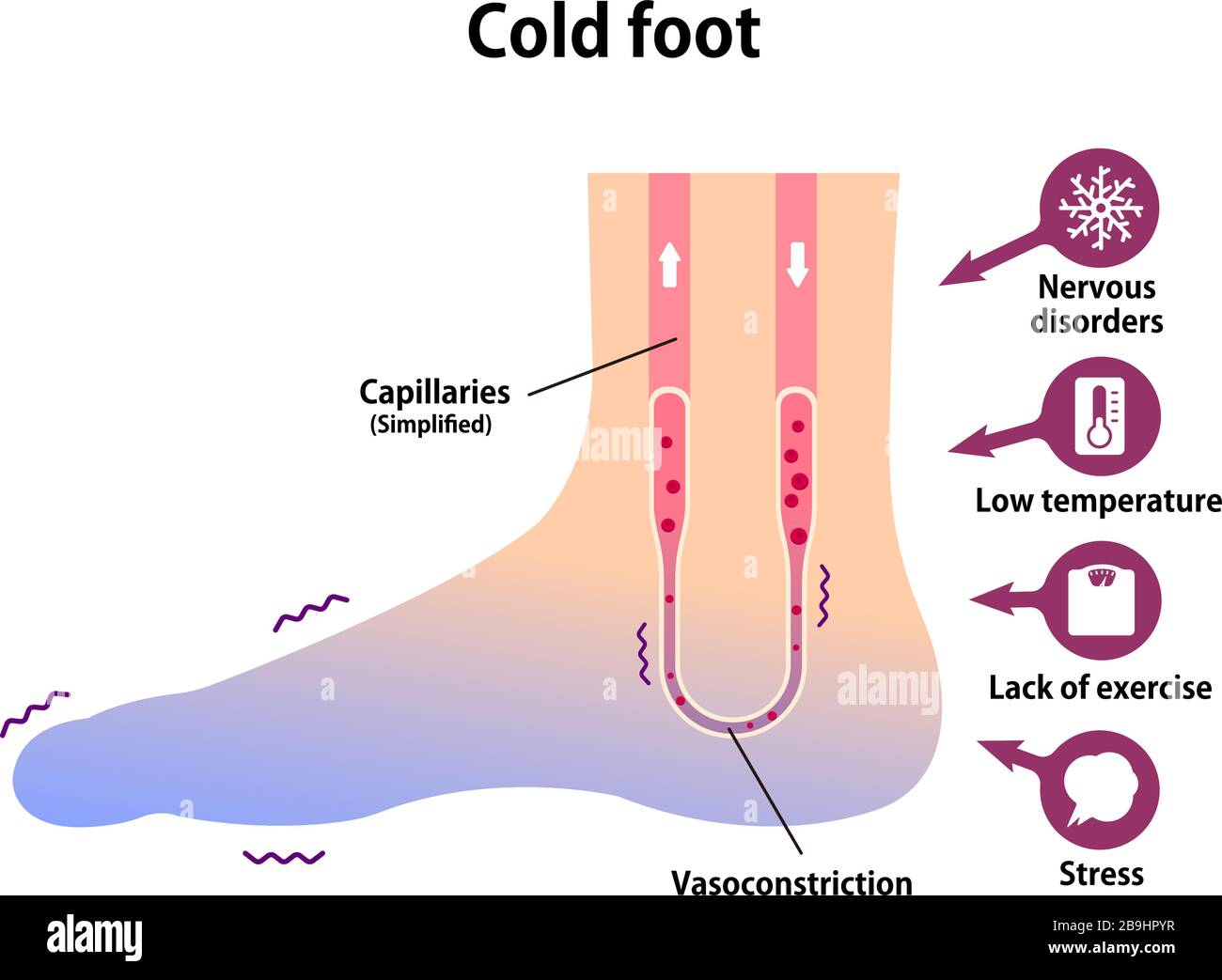 Poor Circulation High Resolution Stock Photography and Images Alamy