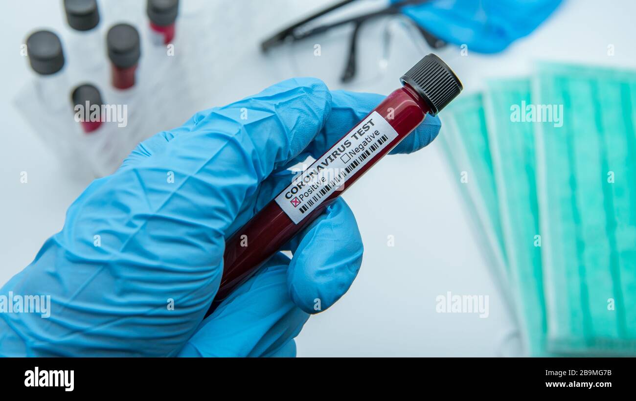 Positive COVID-19 test and laboratory sample of blood testing for diagnosis new Corona virus infection. Disease 2019 from Wuhan. Pandemic infectious c Stock Photo