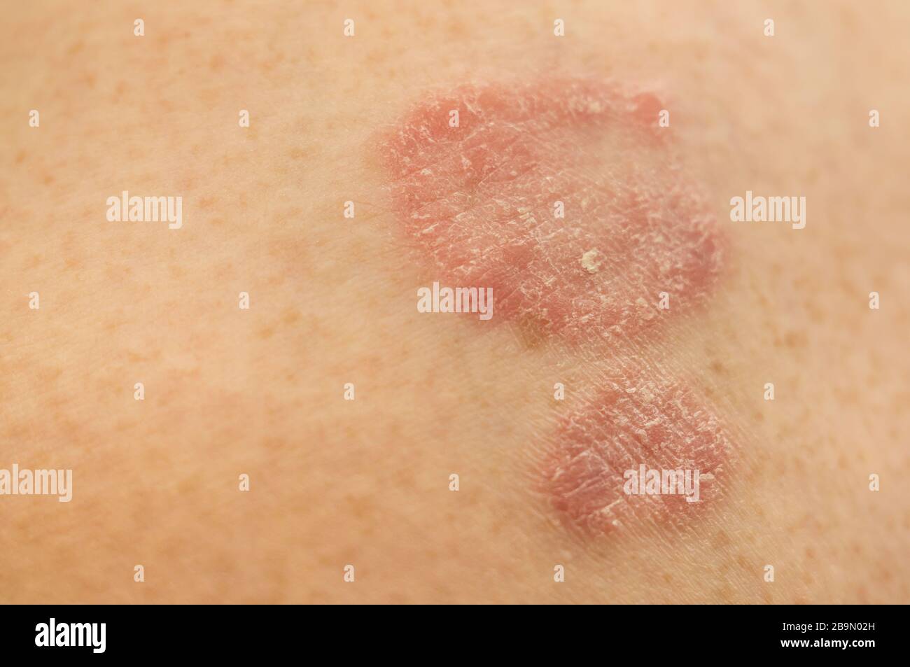Psoriasis skin. Two psoriatic plaques on light skin. Psoriasis is an incurable autoimmune human disease.Soft focus. Stock Photo