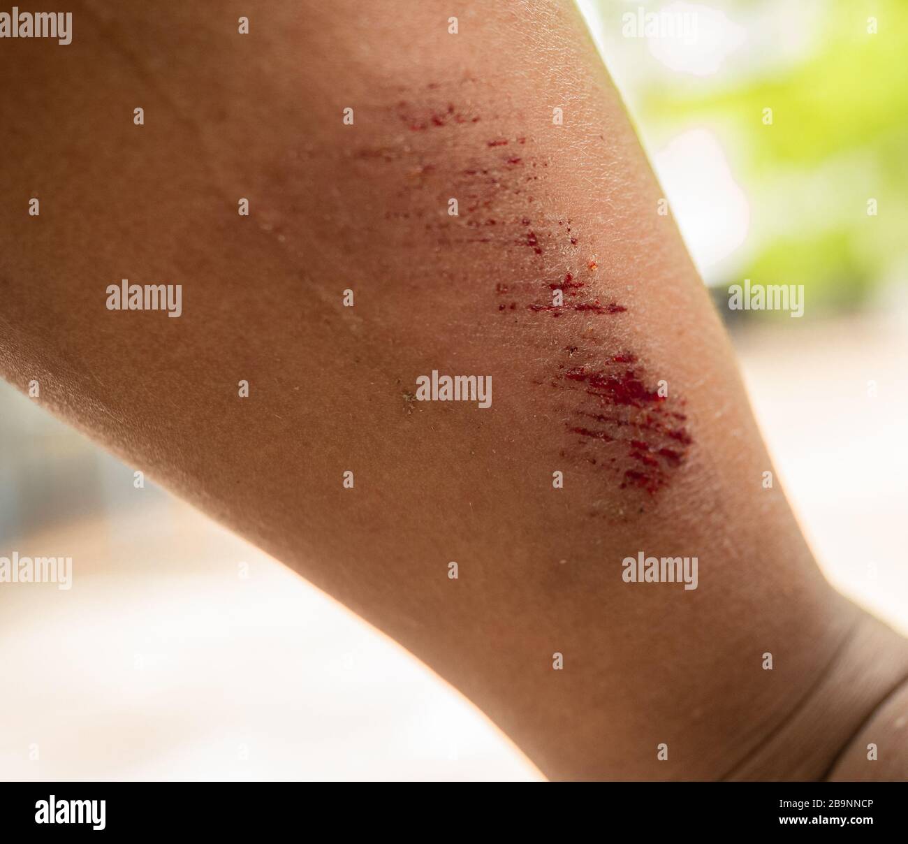 Skin scrape knee child hires stock photography and images Alamy