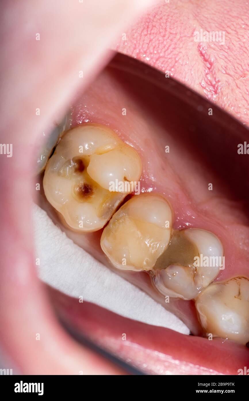 Dental caries. Filling with dental composite photopolymer material