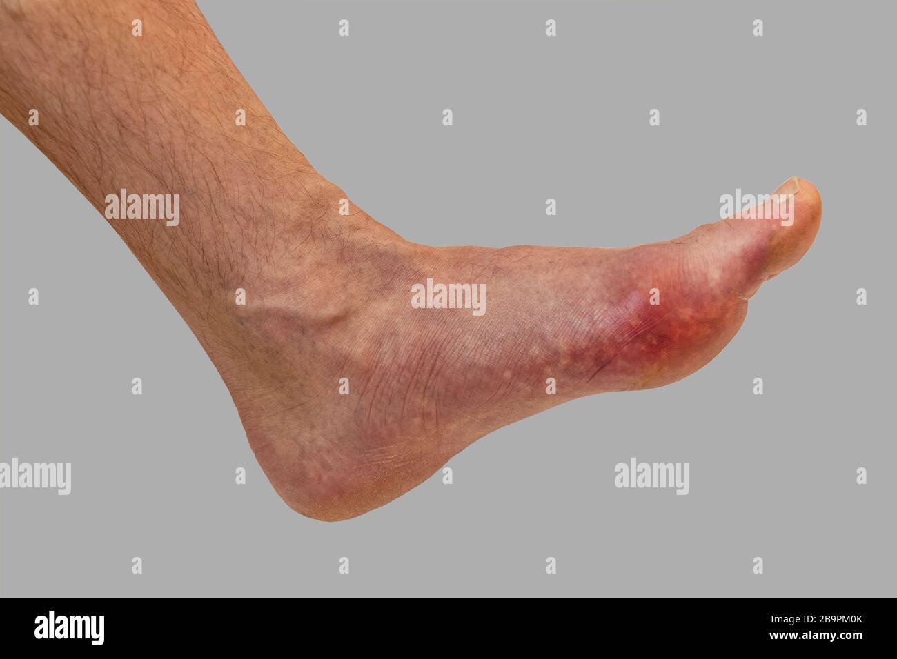 Foot disease Rheumatism and gout. Red leg swelling. Pain in the foot Stock Photo