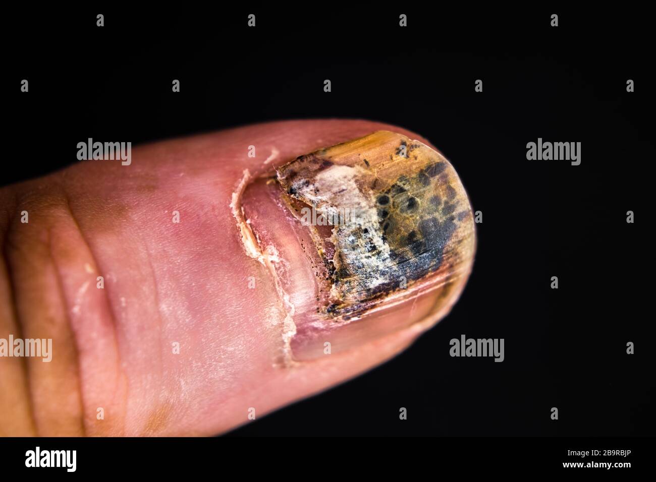 Onycholysis, Detachment Of Nail From Nailbed Stock Photo