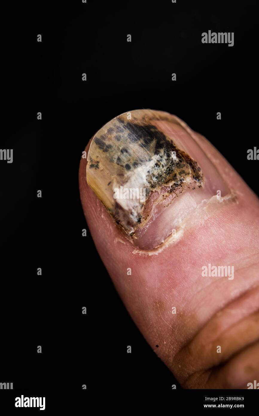 Onycholysis, Detachment Of Nail From Nailbed Stock Photo