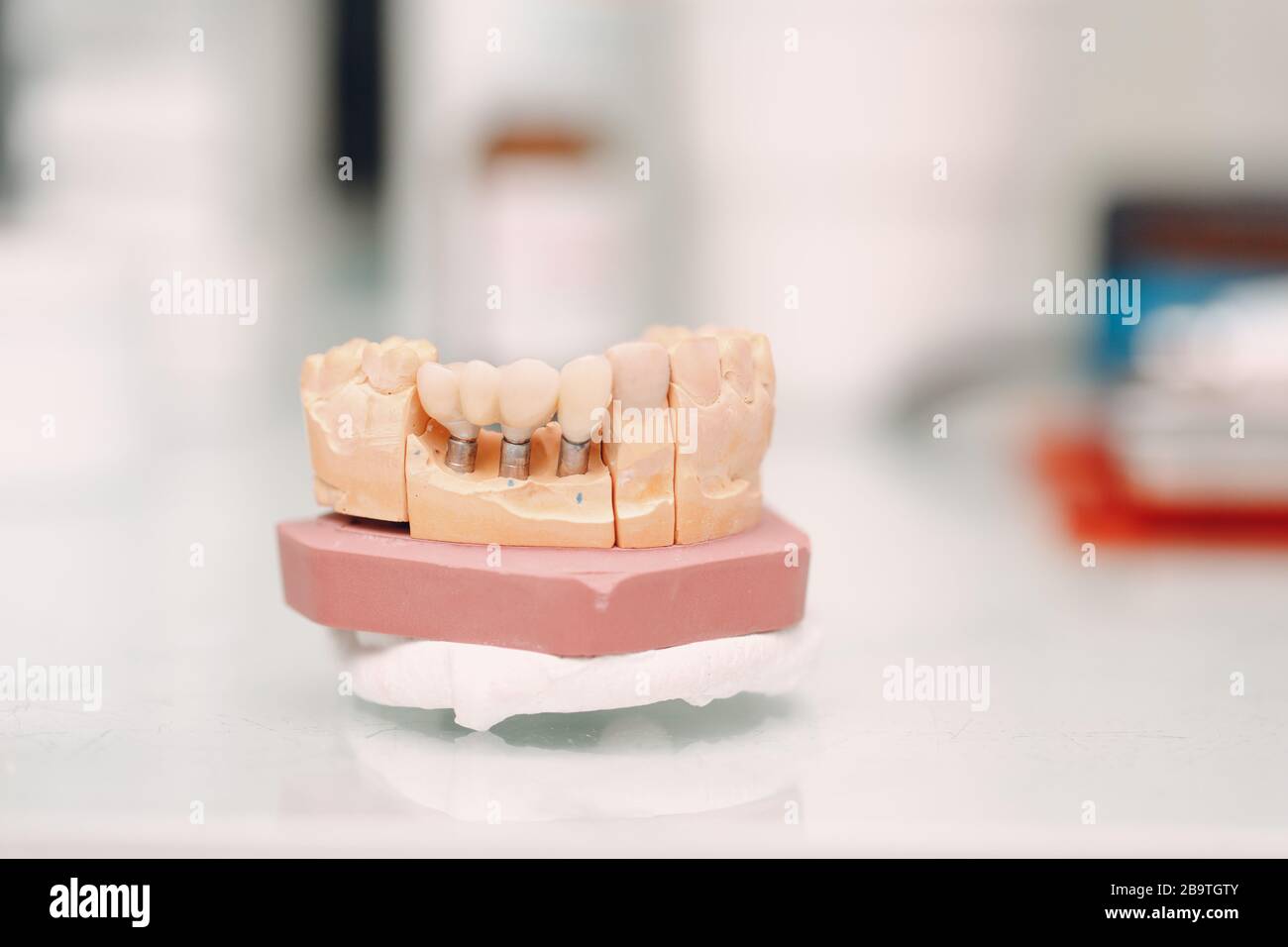 Dental layout of the human jaw with teeth and implants Stock Photo - Alamy