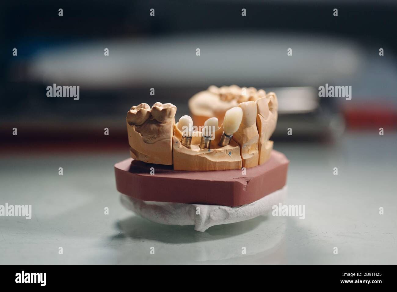 Dental layout of the human jaw with teeth and implants Stock Photo - Alamy