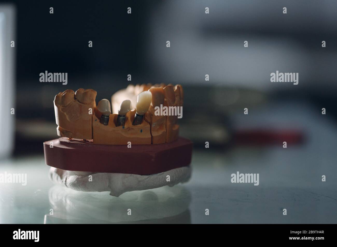 Dental layout of the human jaw with teeth and implants Stock Photo - Alamy