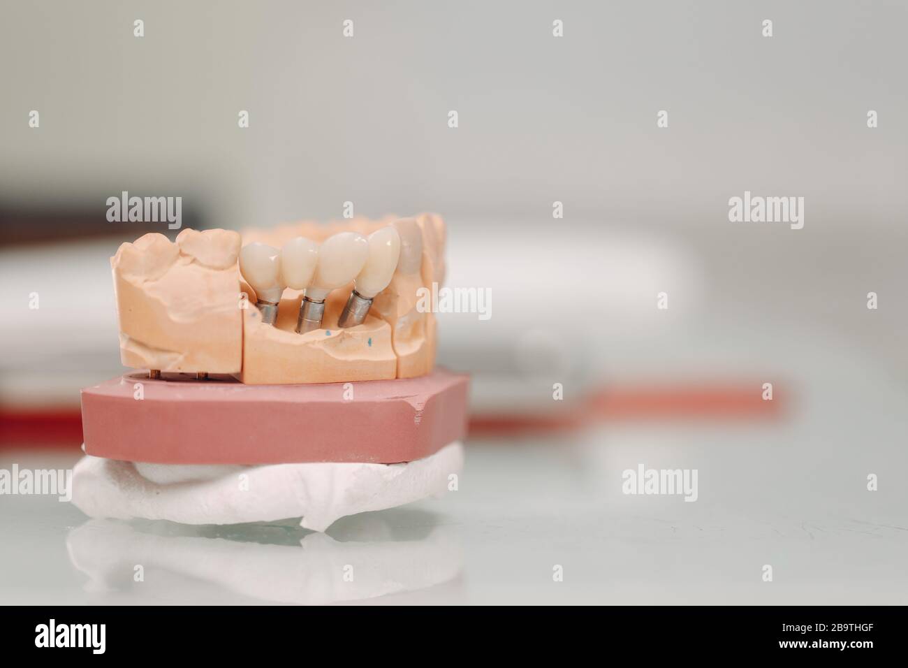 Dental layout of the human jaw with teeth and implants Stock Photo - Alamy
