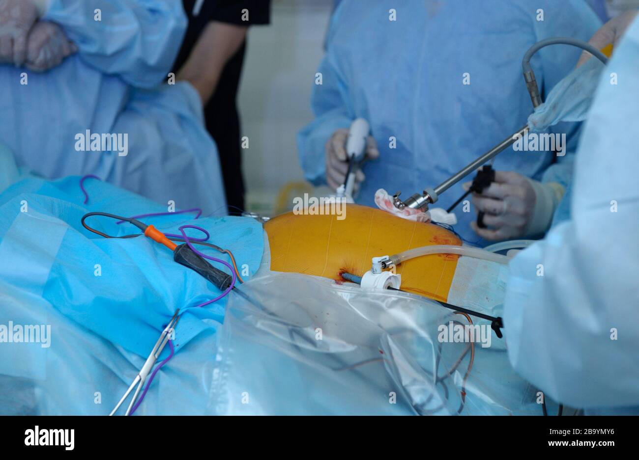 Laparoscopy surgery. Surgeon hand holding laparoscopic instrument attached to a patient belly. Stock Photo