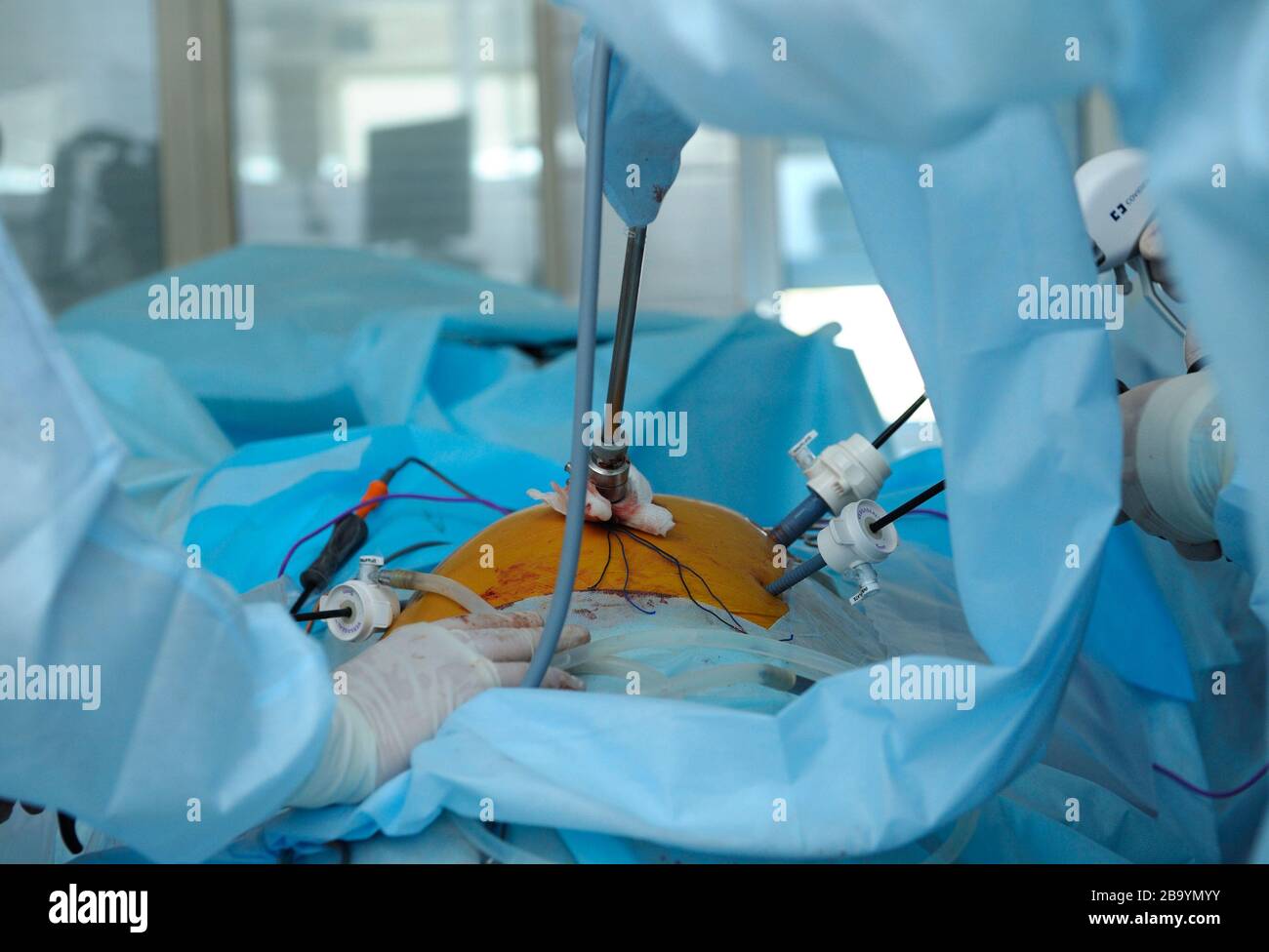 Laparoscopy surgery. Surgeon hand holding laparoscopic instrument attached to a patient belly. Stock Photo
