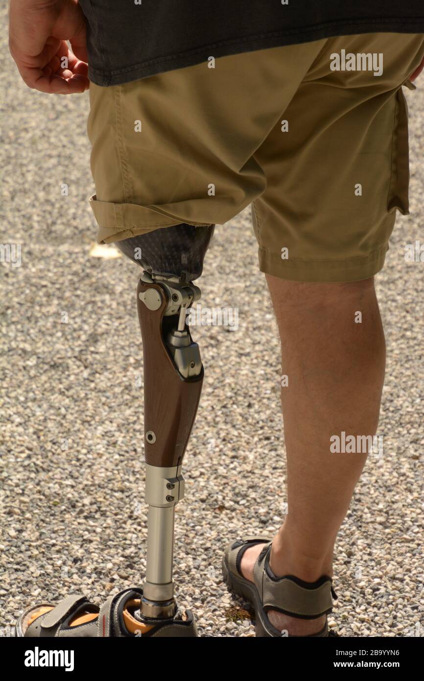 left leg prosthesis selfassured man wearing shorts, man with amputee