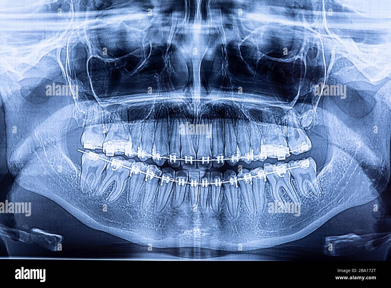 Dental x-ray with braces. Radiography for teeth straightening and dental structures research concept. Stock Photo