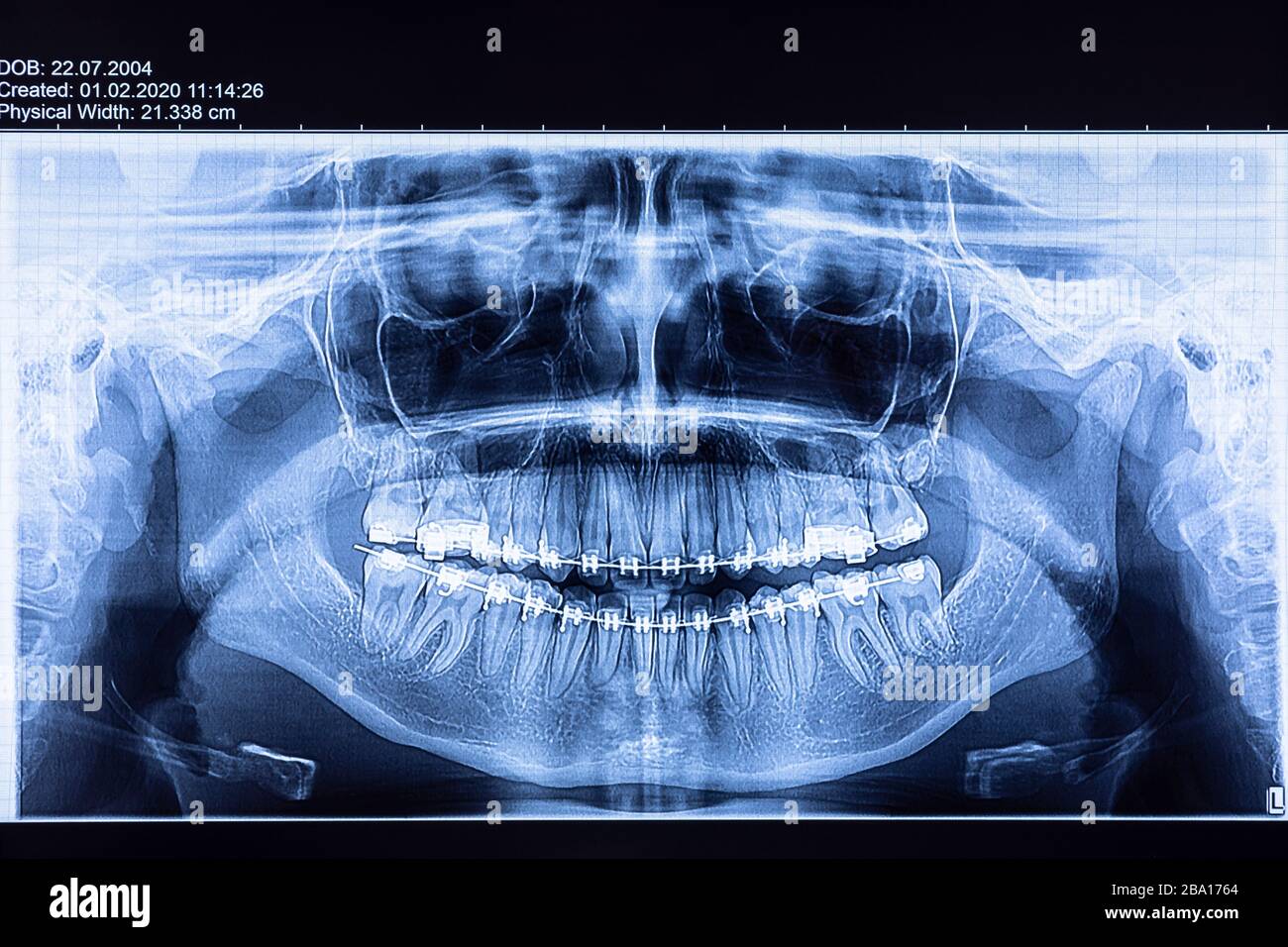 Dental x-ray with braces. Radiography for teeth straightening and dental structures research concept. Stock Photo