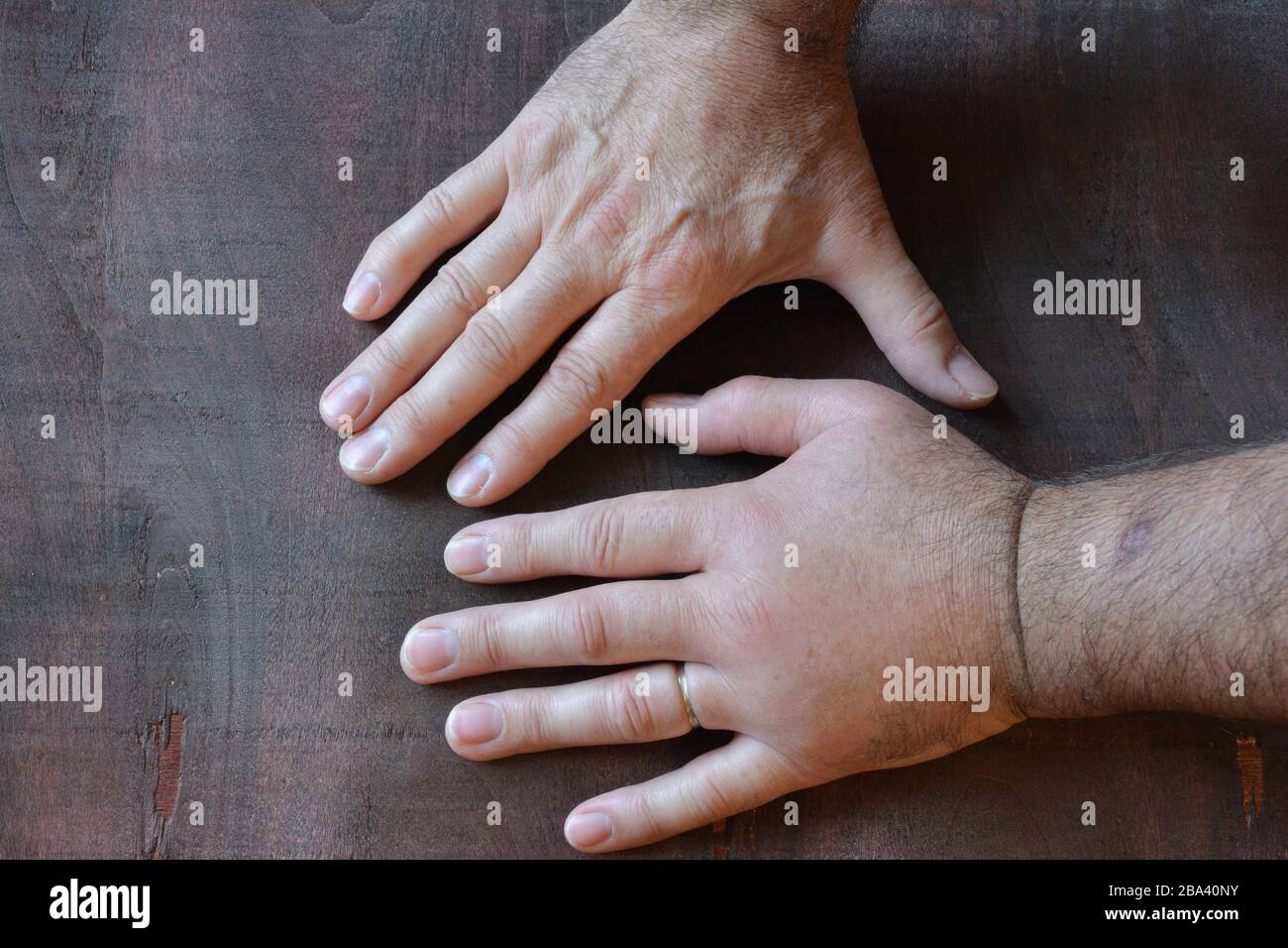 A swollen fist from a sting of a wasp compared to a healthy fist over dark wooden background Stock Photo