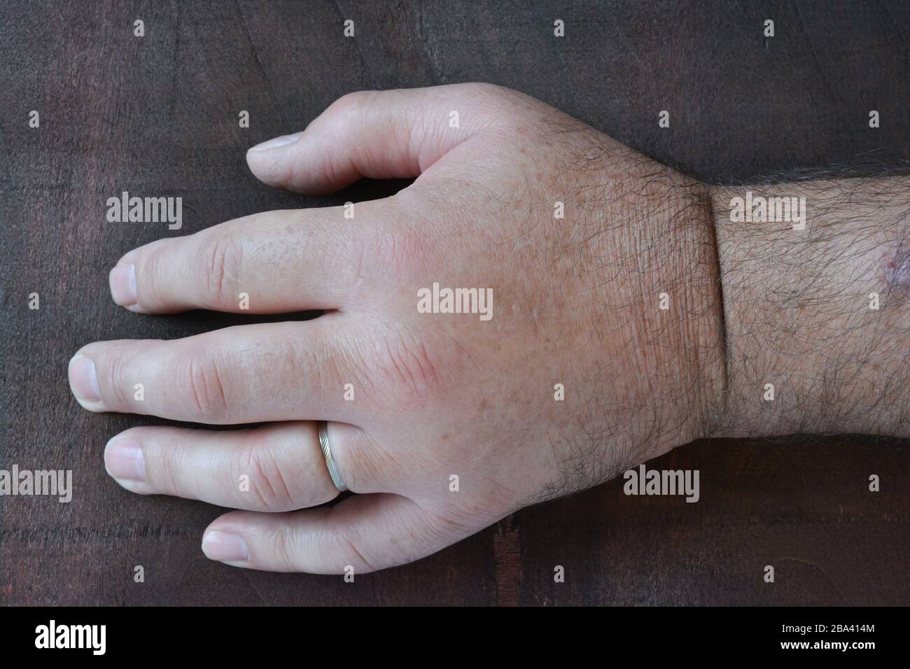 Swollen fist due to the sting of the wasp on dark wooden background, close up view Stock Photo