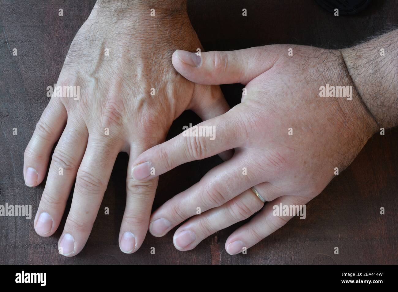 A swollen fist from a sting of a wasp compared to a healthy fist over dark wooden background, close up view Stock Photo