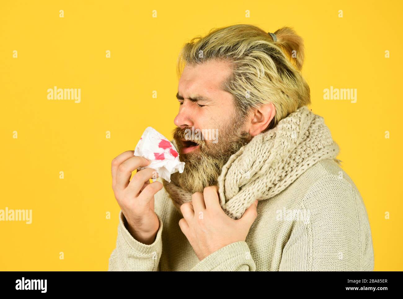 Stuffed Nose Brutal Man Runny Nose Epidemic Concept Guy Blow Out Nose In Paper With Blood Allergic Reaction Nose Bleed Against Virus Or Bacteria Flu Virus Coronavirus Outbreak Home Treatment Stock Photo