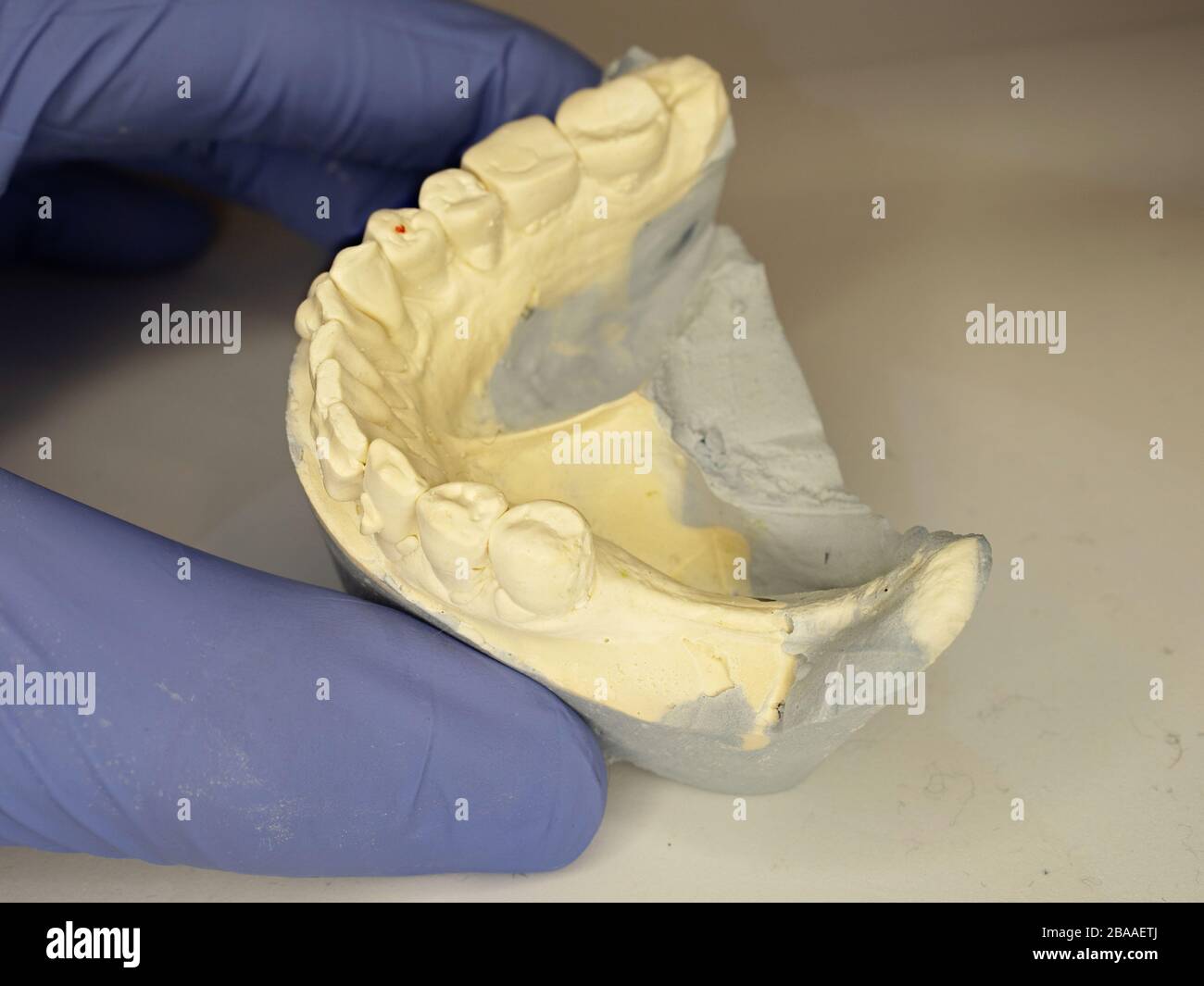 Dental gypsum mold with crooked teeth. Dentist holding Dental Gypsum