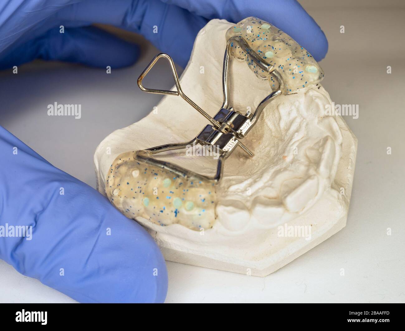 How set right children braces. Test Hyrax rapid palatal expander on