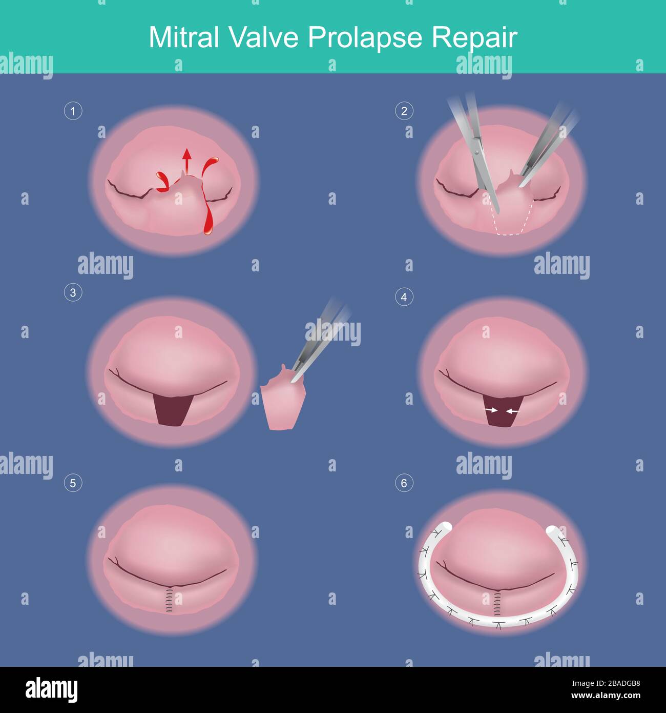 Mitral Valve Prolapse Repair. The method repair heart valve by surgery removed damaged or abnormal leaked segment and used Synthetic material ring (me Stock Vector