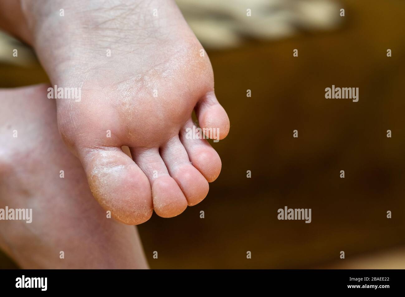 cracked skin under toes child