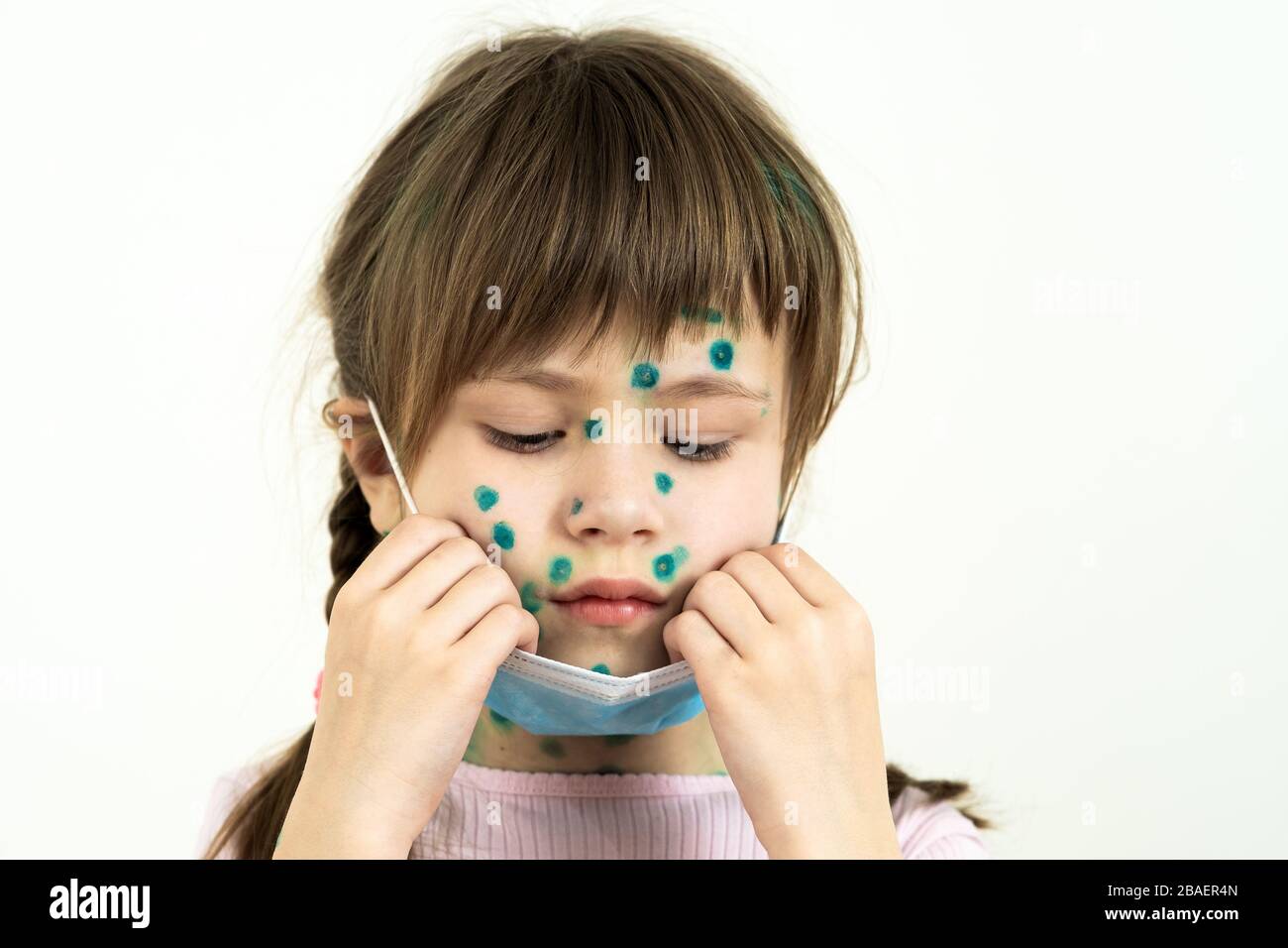 Child girl wearing blue protective medical mask ill with chickenpox, measles or rubella virus with rashes on body. Children protection during epidemic Stock Photo